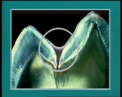 Fissurenversiegelung Fissurenversiegelung