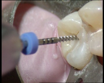 Zahnarztpraxis Singer Ihr Zahn Muss Wurzelbehandelt Werden